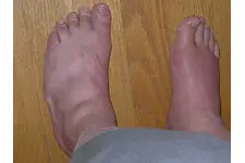 Gut Hastalığı Nasıl Geçer?