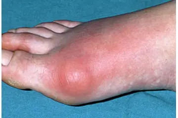 Gut Artriti Belirtileri ve Tedavisi